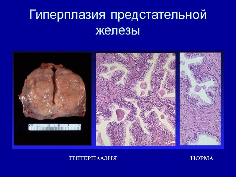 Гиперплазия предстательной железы НОРМА ГИПЕРПЛАЗИЯ